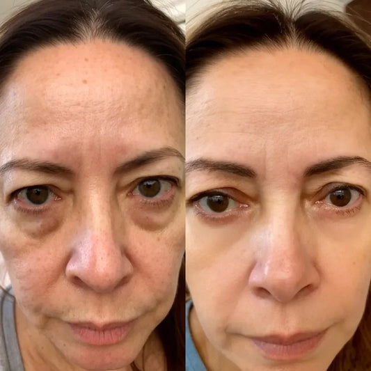 Clarvée EyeRevive® — Terapia LED + EMS para Eliminar Bolsas y Ojeras