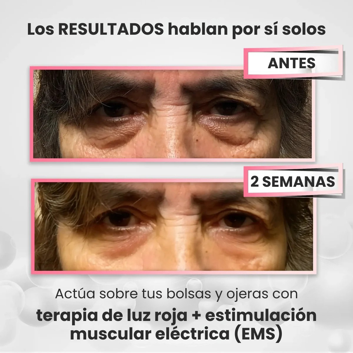 Clarvée EyeRevive® — Terapia LED + EMS para Eliminar Bolsas y Ojeras