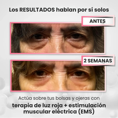 Clarvée EyeRevive® — Terapia LED + EMS para Eliminar Bolsas y Ojeras